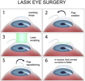 LASIK-Eye-Surgery-procedure-NYC (1)